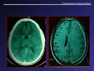 Traumatismo Cranioencefálico 