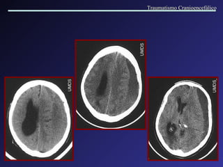 Traumatismo Cranioencefálico 