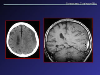 Traumatismo Cranioencefálico 