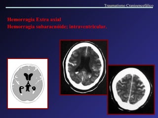 Hemorragia Extra axial  Hemorragia subaracnóide; intraventricular. Traumatismo Cranioencefálico 