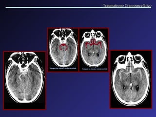 Traumatismo Cranioencefálico 