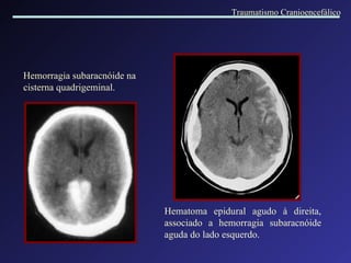 Hematoma epidural agudo à direita, associado a hemorragia subaracnóide aguda do lado esquerdo.   Hemorragia subaracnóide na cisterna quadrigeminal. Traumatismo Cranioencefálico 