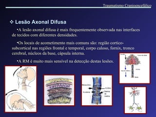 Lesão Axonal Difusa A lesão axonal difusa é mais frequentemente observada nas interfaces de tecidos com diferentes densidades. Os locais de acometimento mais comuns são: região cortico-subcortical nas regiões frontal e t emporal , corpo caloso,  fornix,  tronco cerebral, núcleos da base,  c á psul a interna. A RM é muito mais sensível na detecção destas lesões. Traumatismo Cranioencefálico 