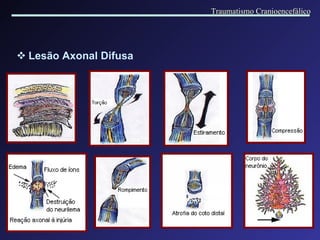 Lesão Axonal Difusa Traumatismo Cranioencefálico 