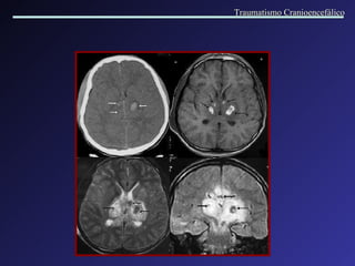 Traumatismo Cranioencefálico 