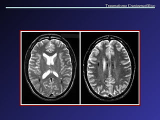 Traumatismo Cranioencefálico 