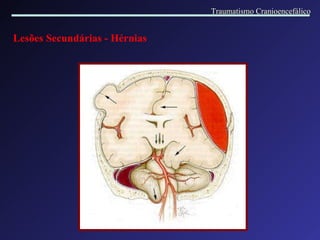 Lesões Secundárias -   Hérnias Traumatismo Cranioencefálico 