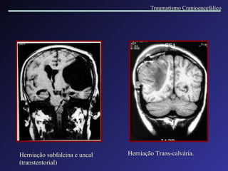 Herniação subfalcina e uncal (transtentorial) Herniação Trans-calvária. Traumatismo Cranioencefálico 