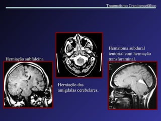 Herniação subfalcina Herniação das amigdalas cerebelares. Hematoma subdural tentorial com herniação transforaminal. Traumatismo Cranioencefálico 