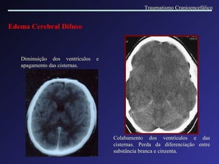 Edema Cerebral Difuso D iminuição dos ventrículos e apagamento das cisternas. Colabamento dos ventrículos e das cisternas. Perda da diferenciação entre substância branca e cinzenta . Traumatismo Cranioencefálico 