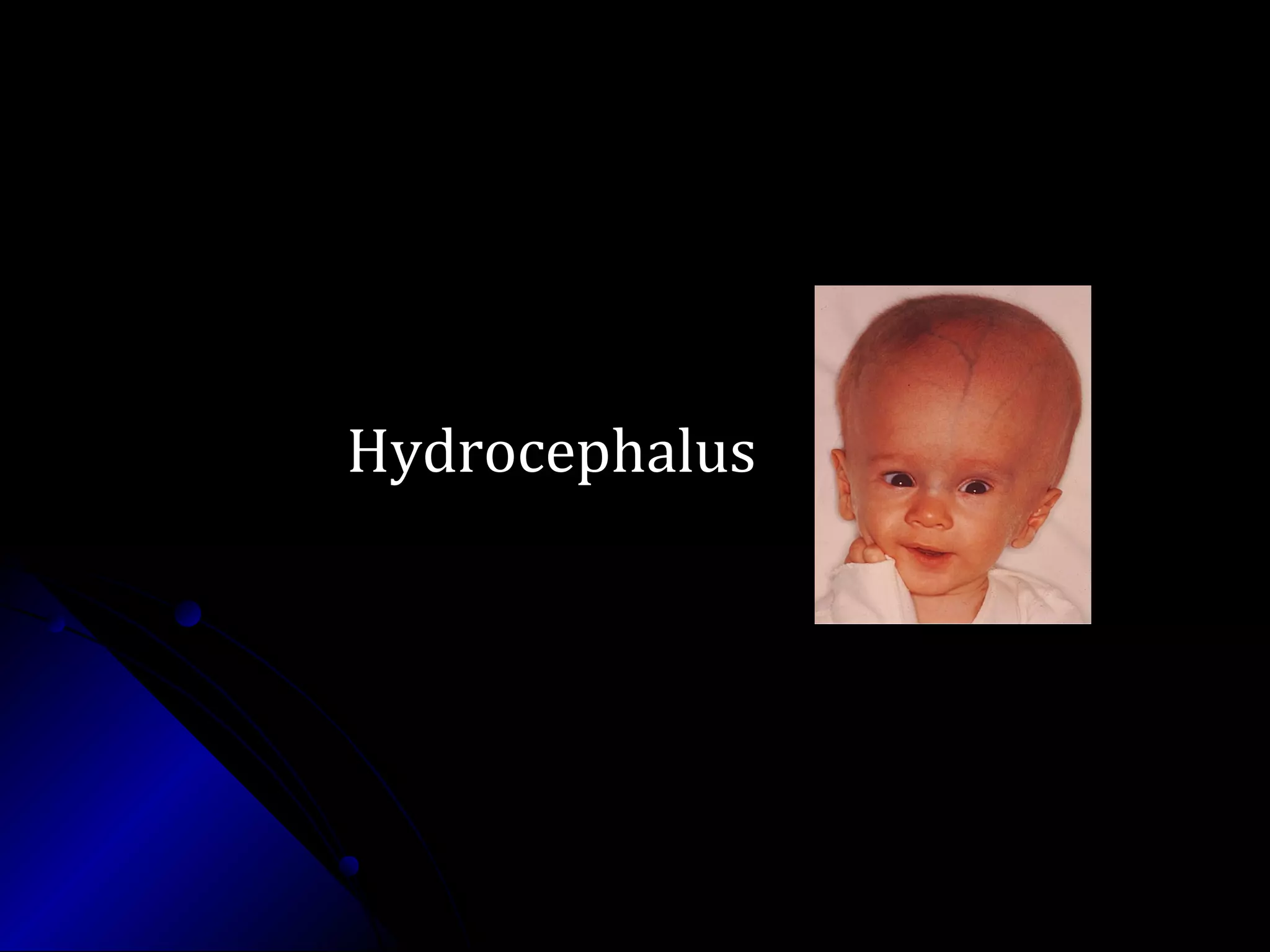 HydrocephalusHydrocephalus
 