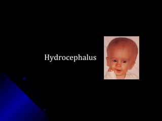 HydrocephalusHydrocephalus
 