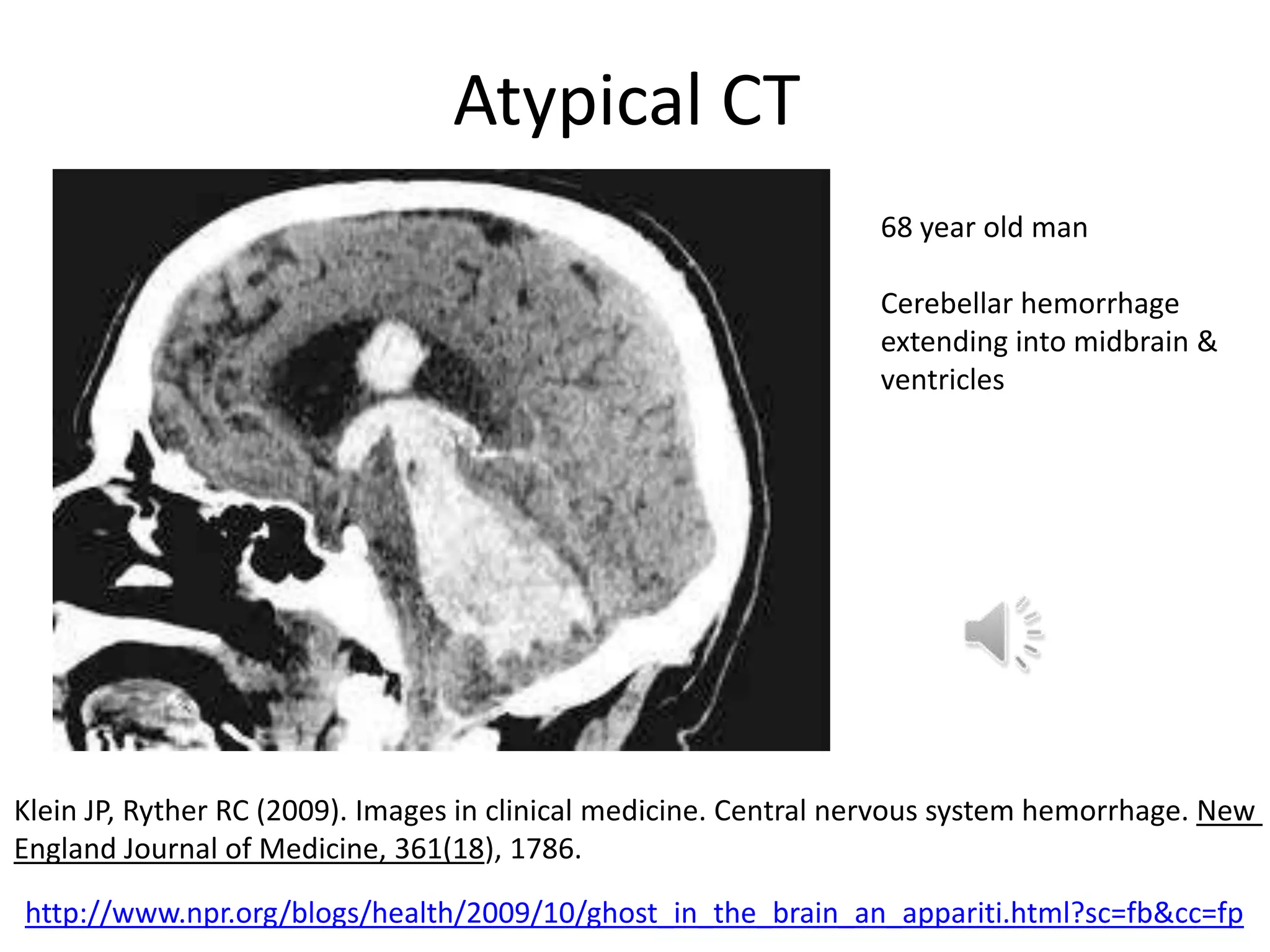 Atypical CT
                                                                  68 year old man

                                                                  Cerebellar hemorrhage
                                                                  extending into midbrain &
                                                                  ventricles




Klein JP, Ryther RC (2009). Images in clinical medicine. Central nervous system hemorrhage. New
England Journal of Medicine, 361(18), 1786.

http://www.npr.org/blogs/health/2009/10/ghost_in_the_brain_an_appariti.html?sc=fb&cc=fp
 