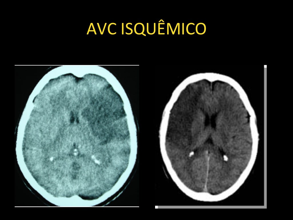 Neurorradiologia AVC isquêmico e hemorrágico Neurorradiologia AVC isquêmico e hemorrágico