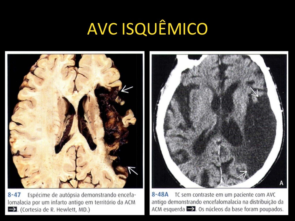 Neurorradiologia AVC isquêmico e hemorrágico Neurorradiologia AVC isquêmico e hemorrágico