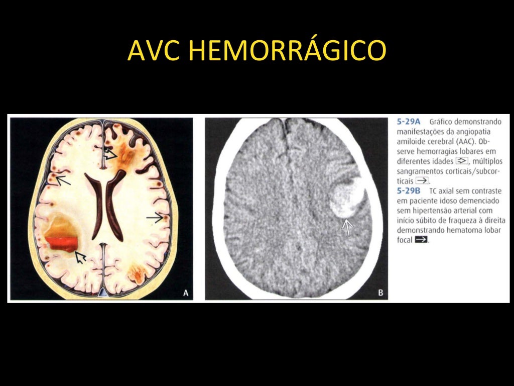 Neurorradiologia AVC isquêmico e hemorrágico Neurorradiologia AVC isquêmico e hemorrágico
