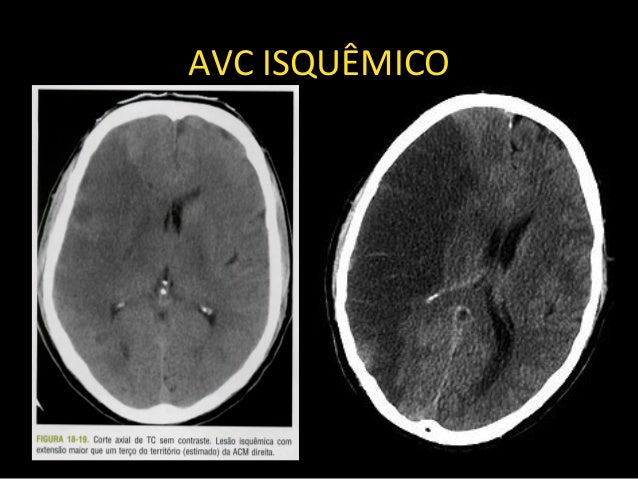 Neurorradiologia AVC isquêmico e hemorrágico