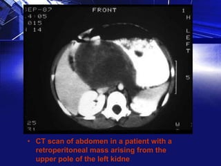 • CT scan of abdomen in a patient with a
retroperitoneal mass arising from the
upper pole of the left kidne

 