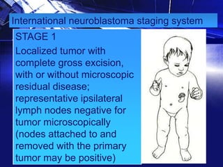 International neuroblastoma staging system
STAGE 1
Localized tumor with
complete gross excision,
with or without microscopic
residual disease;
representative ipsilateral
lymph nodes negative for
tumor microscopically
(nodes attached to and
removed with the primary
tumor may be positive)

 