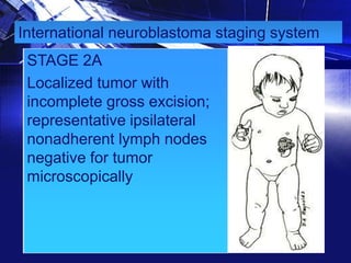 International neuroblastoma staging system

STAGE 2A
Localized tumor with
incomplete gross excision;
representative ipsilateral
nonadherent lymph nodes
negative for tumor
microscopically

 