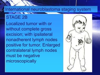 International neuroblastoma staging system
STAGE 2B
Localized tumor with or
without complete gross
excision; with ipsilateral
nonadherent lymph nodes
positive for tumor. Enlarged
contralateral lymph nodes
must be negative
microscopically

 