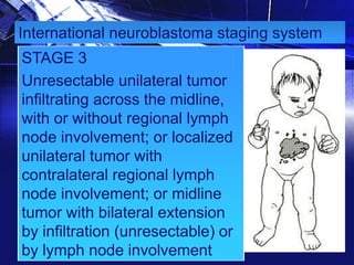 International neuroblastoma staging system

STAGE 3
Unresectable unilateral tumor
infiltrating across the midline,
with or without regional lymph
node involvement; or localized
unilateral tumor with
contralateral regional lymph
node involvement; or midline
tumor with bilateral extension
by infiltration (unresectable) or
by lymph node involvement

 