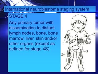 International neuroblastoma staging system
STAGE 4
Any primary tumor with
dissemination to distant
lymph nodes, bone, bone
marrow, liver, skin and/or
other organs (except as
defined for stage 4S)

 
