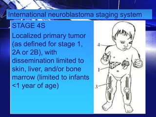 International neuroblastoma staging system
STAGE 4S
Localized primary tumor
(as defined for stage 1,
2A or 2B), with
dissemination limited to
skin, liver, and/or bone
marrow (limited to infants
<1 year of age)

 