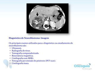 Diagnóstico de Neuroblastoma: Imagem
Os principais exames utilizados para o diagnóstico ou estadiamento do
neuroblastoma são:
• Ultrassom.
• Radiografia de tórax.
• Tomografia computadorizada.
• Ressonância magnética.
• Cintilografia com MIBG.
• Tomografia por emissão de pósitrons (PET scan).
• Cintilografia óssea.
 