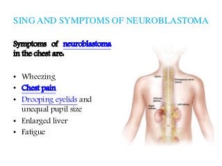 neuroblastoma