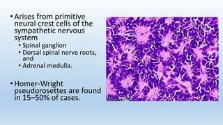 • Arises from primitive
neural crest cells of the
sympathetic nervous
system
• Spinal ganglion
• Dorsal spinal nerve roots,
and
• Adrenal medulla.
• Homer-Wright
pseudorosettes are found
in 15–50% of cases.
 