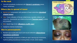 In the neck
 Cervical sympathetic involvement with Horner’s syndrome (ptosis,
miosis, anhidrosis)
Others due to spread of tumor
 Spinal cord compression with paralysis of lower extremities (dumbbell
shaped tumor)
 Eye- Tumor infiltration of the per orbital bones, typically unilateral, can
cause the characteristic per orbital ecchymosis ("raccoon eyes"), ptosis,
and proptosis
 Skin- bluish tinge of skin (Blueberry muffin sign)
 Cytopenia (marrow involvement)
Due to paraneoplastic
 Random eye muscle jerks due to anti-neural antibodies (Opsoclonus
myoclonus syndrome)
 The characteristic symptoms of OMA are rapid, dancing eye movements,
rhythmic jerking (myoclonus) involving limbs or trunk, and/or ataxia.
 