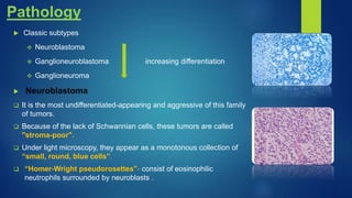 Pathology
 Classic subtypes
 Neuroblastoma
 Ganglioneuroblastoma increasing differentiation
 Ganglioneuroma
 Neuroblastoma
 It is the most undifferentiated-appearing and aggressive of this family
of tumors.
 Because of the lack of Schwannian cells, these tumors are called
"stroma-poor".
 Under light microscopy, they appear as a monotonous collection of
“small, round, blue cells”.
 “Homer-Wright pseudorosettes”- consist of eosinophilic
neutrophils surrounded by neuroblasts .
 