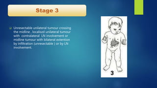  Unresectable unilateral tumour crossing
the midline , localiszd unilateral tumour
with contralateral LN involvement or
midline tumour with bilateral extention
by infiltration (unresectable ) or by LN
involvement.
 