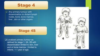  Any primary tumour with
dissemination to distant lymph
nodes, bone ,bone marrow,
liver , skin or other organs
 Localized primary tumour as
defined for stage 1, 2A, 2B with
dissemination limited to skin, liver
and or bone marrow. ( limited to
infants < 1 year of age.
 