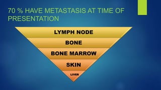70 % HAVE METASTASIS AT TIME OF
PRESENTATION
LYMPH NODE
BONE
BONE MARROW
SKIN
LIVER
 