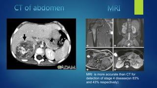 MRI is more accurate than CT for
detection of stage 4 disease(sn 83%
and 43% respectively)
 