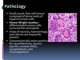 Pathology
 Small,round, blue cell tumour
composed of dense nests of
hyperchromatic cells.
 HomerWright rosettes-
differentiated tumour cells
surround the neutrophils.
 Areas of necrosis, haemorrhage,
and calcium are frequently
present.
 Characteristically stains positive
for neurofilaments, neuron-
specificc enolase (NSE),
synaptophysin, and
chromograninA.
 