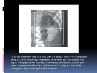 Radiation treatment field for a child with left adrenal primary neuroblastoma
and para-aortic lymph node metastases.The beam’s eye view display with
digital radiograph allows for adequate coverage of the target volume and
lymph node region with sparing of the ipsilateral kidney and liver while
homogeneously irradiating the adjavent spine.
 