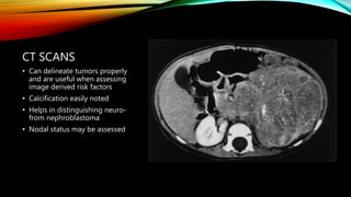 CT SCANS
• Can delineate tumors properly
and are useful when assessing
image derived risk factors
• Calcification easily noted
• Helps in distinguishing neuro-
from nephroblastoma
• Nodal status may be assessed
 