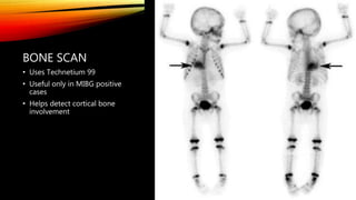 BONE SCAN
• Uses Technetium 99
• Useful only in MIBG positive
cases
• Helps detect cortical bone
involvement
 