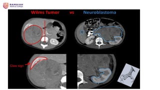 Shimada Classification NEUROBLASTOMA definition and types and classification | PPTX