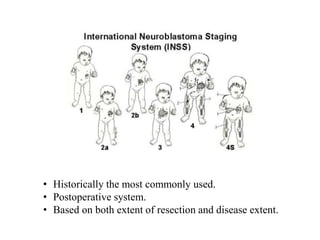 • Historically the most commonly used.
• Postoperative system.
• Based on both extent of resection and disease extent.
 