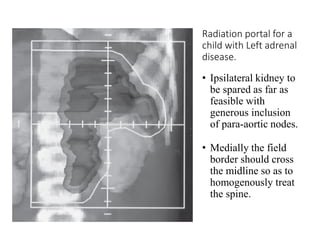 Radiation portal for a
child with Left adrenal
disease.
• Ipsilateral kidney to
be spared as far as
feasible with
generous inclusion
of para-aortic nodes.
• Medially the field
border should cross
the midline so as to
homogenously treat
the spine.
 