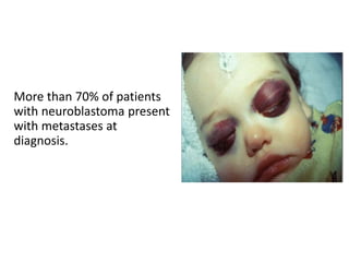More than 70% of patients
with neuroblastoma present
with metastases at
diagnosis.
 