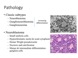 Pathology
• Classic subtypes
- Neuroblastoma
- Ganglioneuroblastoma
- Ganglioneuroma
• Neuroblastoma
- Small uniform cells
- Hyperchromatic nuclei & scant cytoplasm
- Homer Wright pseudorosette
- Necrosis and calcification
- Mature & intermediate differentiation
ganglion cells
increasing
differentiation
 