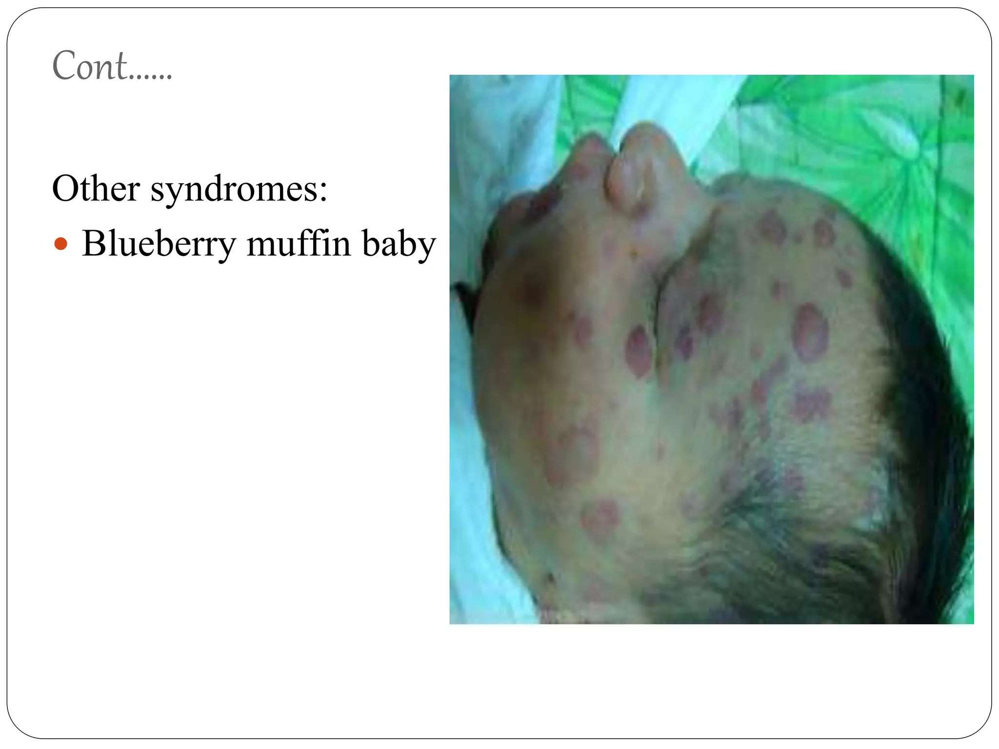 Neuroblastoma | PPTX