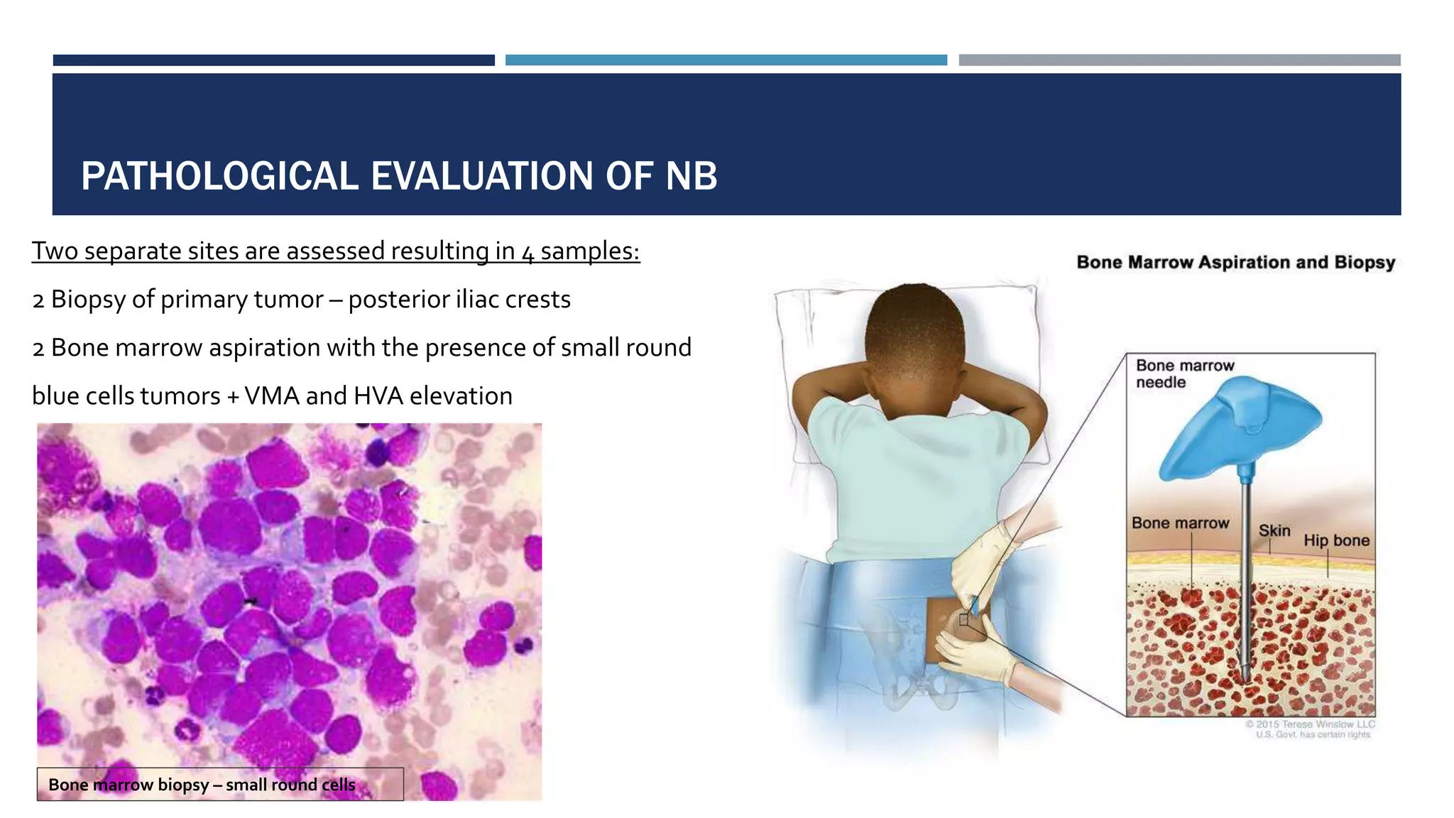 PATHOLOGICAL EVALUATION OF NB
Two separate sites are assessed resulting in 4 samples:
2 Biopsy of primary tumor – posterior iliac crests
2 Bone marrow aspiration with the presence of small round
blue cells tumors +VMA and HVA elevation
Bone marrow biopsy – small round cells
 