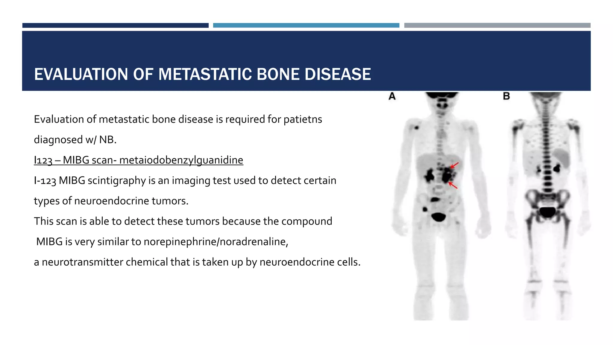 EVALUATION OF METASTATIC BONE DISEASE
Evaluation of metastatic bone disease is required for patietns
diagnosed w/ NB.
I123 – MIBG scan- metaiodobenzylguanidine
I-123 MIBG scintigraphy is an imaging test used to detect certain
types of neuroendocrine tumors.
This scan is able to detect these tumors because the compound
MIBG is very similar to norepinephrine/noradrenaline,
a neurotransmitter chemical that is taken up by neuroendocrine cells.
 