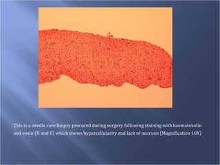 This is a needle core biopsy procured during surgery following staining with haematoxolin  and eosin (H and E) which shows hypercellularity and lack of necrosis (Magnification 10X) 